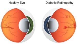 Diabetic Retinopathy vs Healthy Eye
