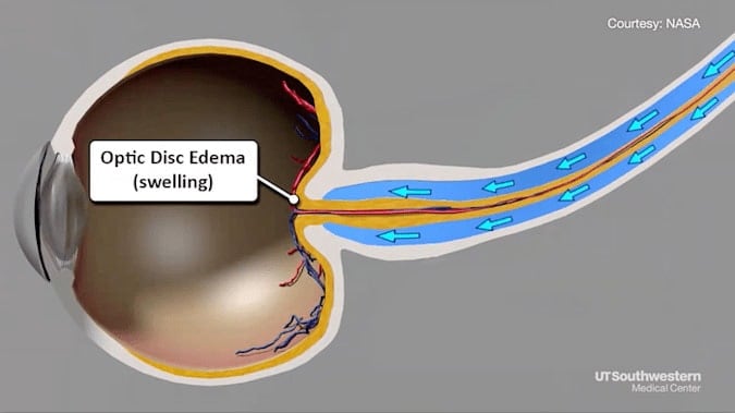 Optic Disc Edema