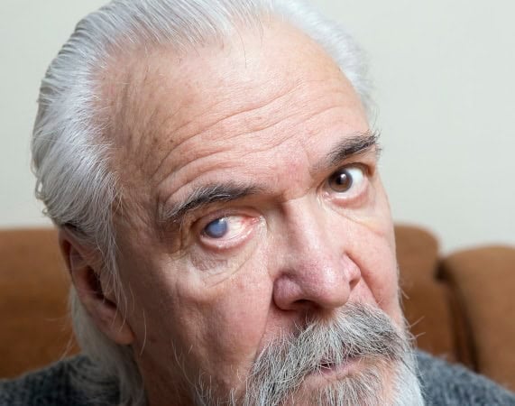 Close-up of an elderly man with cloudy eye, showcasing advanced eye condition.