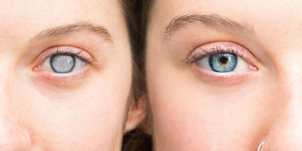 Close-up of a patient with cataracts and healthy eye. Expert eye care and vision correction services.
