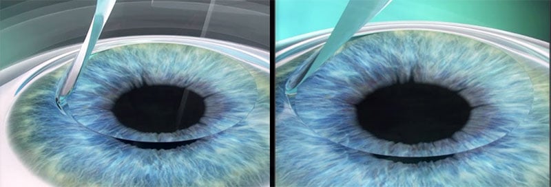 First generation LASIK 1G-LASIK