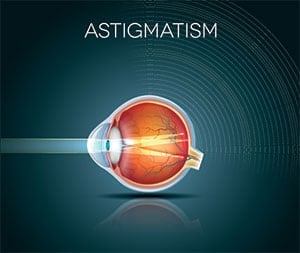 Astigmatism2