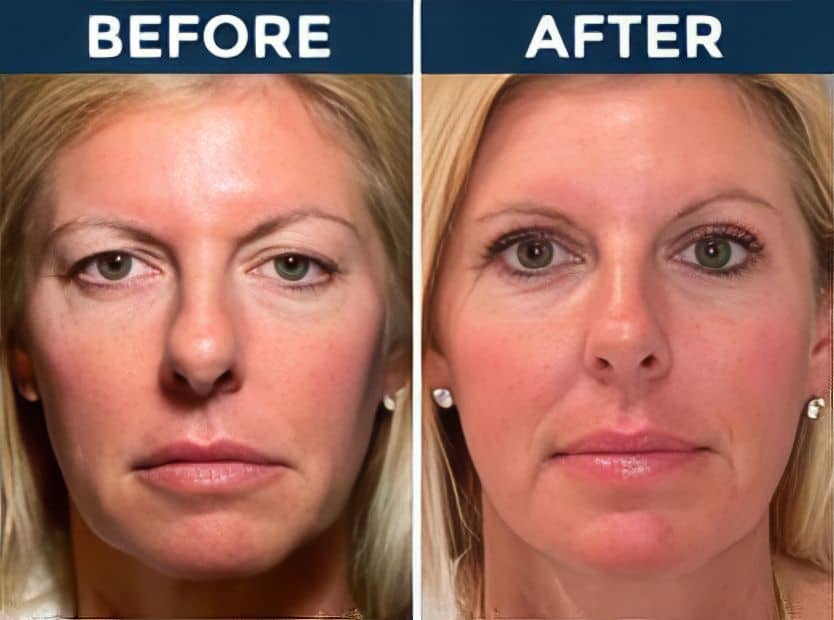 Before and after eyelid surgery results at Assil Gaur Eye Institute.