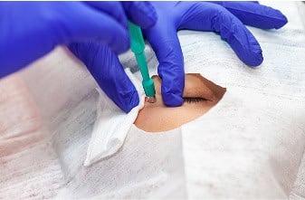 Canthoplasty-Surgery