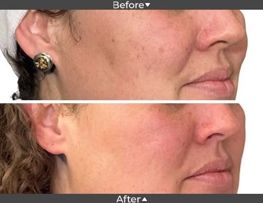 Cosmelan MD peel