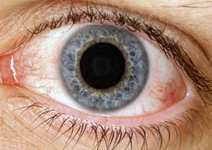 Dry-Eye