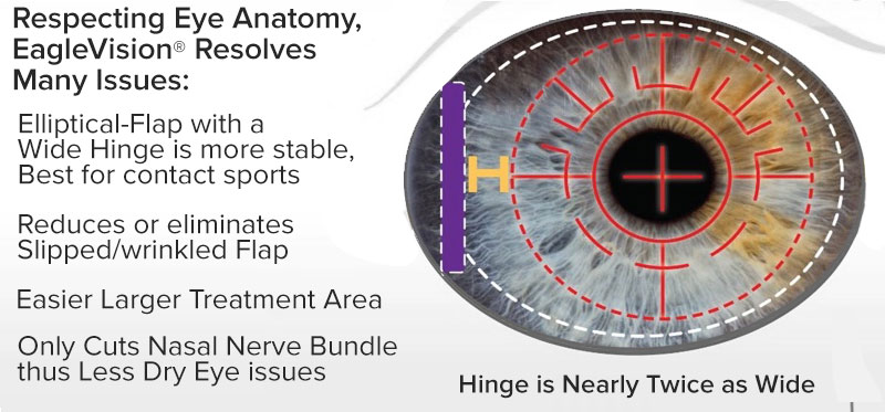 Eaglevision LASIK laser eye surgery Eaglevision-5G-differences
