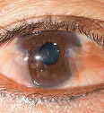 Close-up of human eye showcasing advanced eye care equipment.