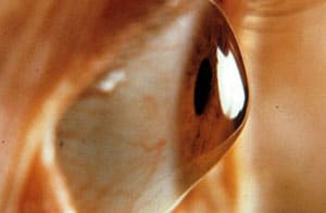 Keratoconus2