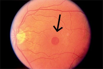 Macular-Hole-Small