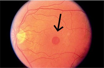 Macular-Holes-&-Macular-Puckers