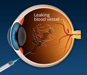Macular-degeneration-2