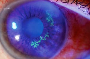 Ocular-Herpes-Simplex-SMALL