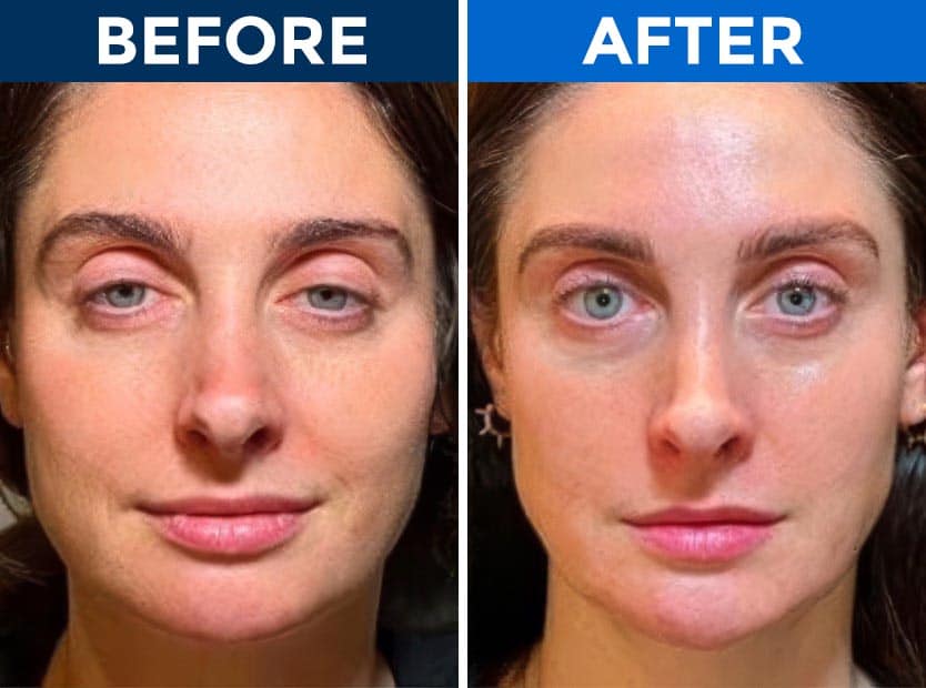 Before and after eyelid surgery results at Assil Gaur Eye Institute.
