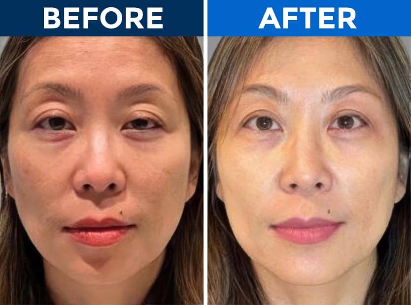 Before and after eyelid surgery at Assil Gaur Eye Institute.