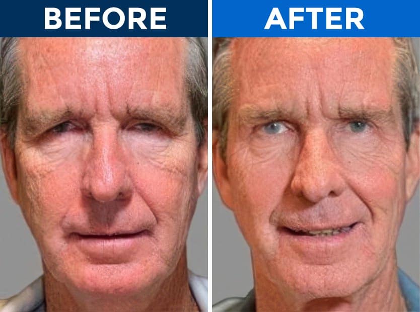 Before and after eyelid surgery results showing rejuvenation.