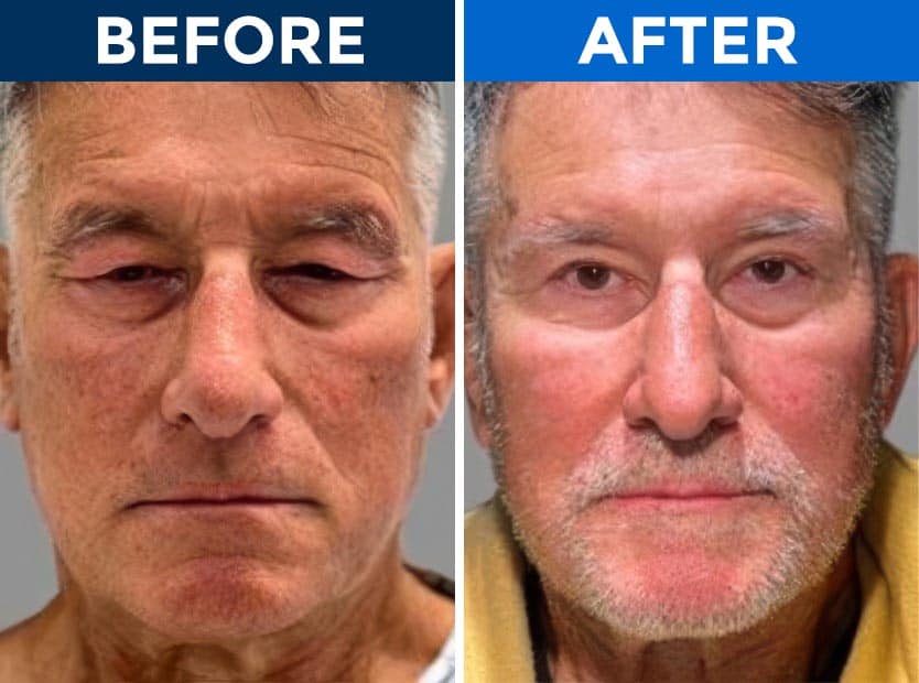 Before and after blepharoplasty results showing eye rejuvenation.