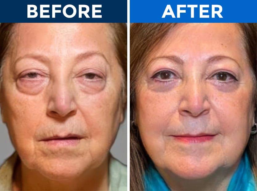 Before and after eyelid surgery results showing reduced drooping eyelids.