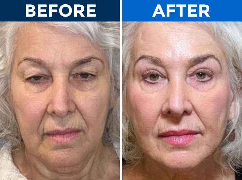 Elderly woman before and after eyelid surgery at Assil Gaur Eye Institute.