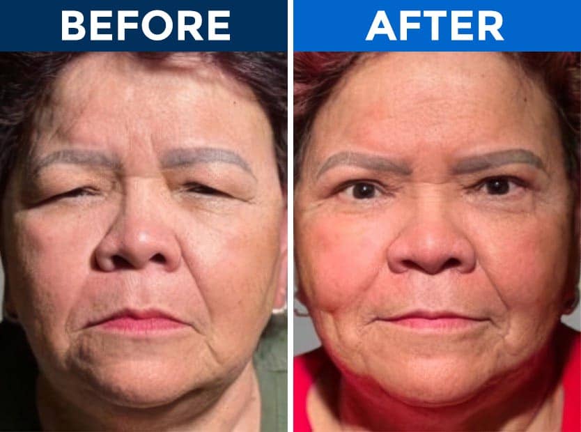 Before and after eyelid surgery at Assil Gaur Eye Institute.