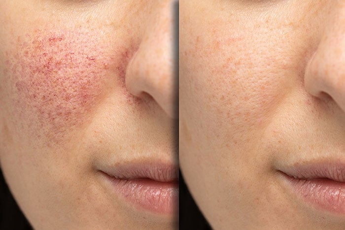 Photofacial-before-and-afterv
