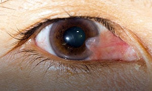 Pterygium-SMALL
