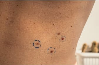 Skin-Tag-&-Cherry-Angioma-Removal