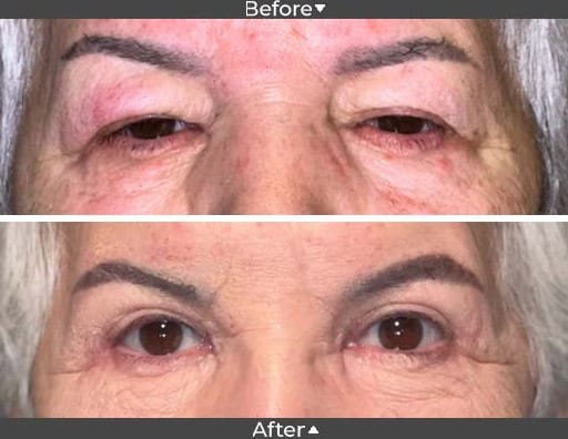 Upper blepharoplasty