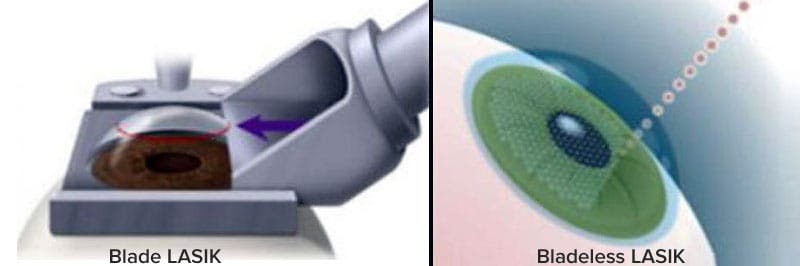 blade_vs_bladeless_lasik2