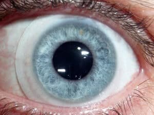 corneal-crosslinking