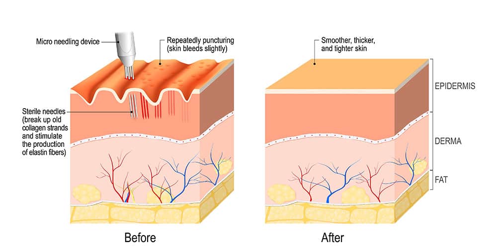 microneedling