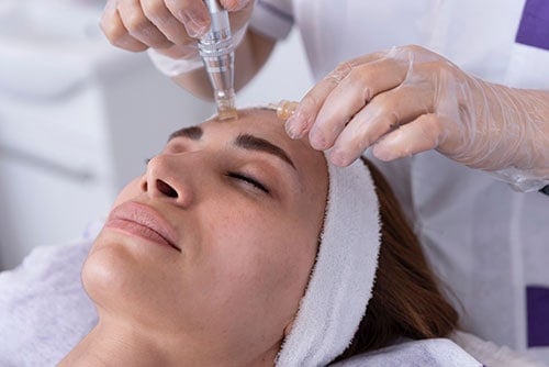 microneedlingv