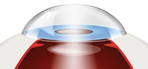refractive-lens-exchange
