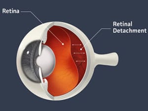 retinal-detachment-diagram
