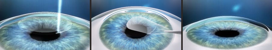 SMILE LASIK surgery smile-in-three-images