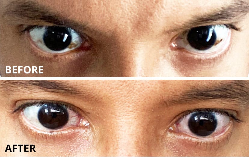 Before-and-After-Eye Nevus-Removal-Larry.jpg
