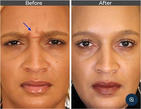 Botox for Forehead Elevens