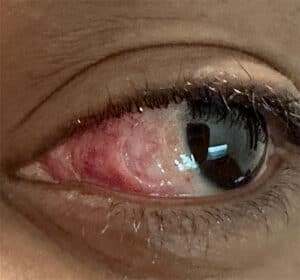 Kevin-Inner-Eye-Freckle