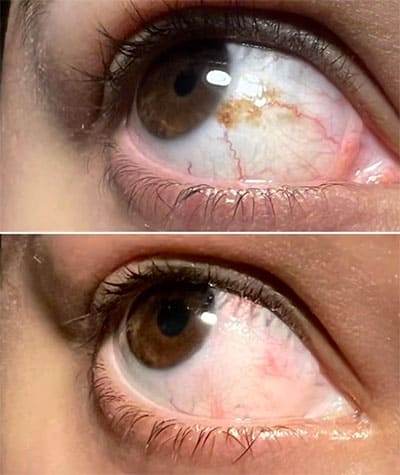 Nevus removal surgery Nevus-removal-before-and-after