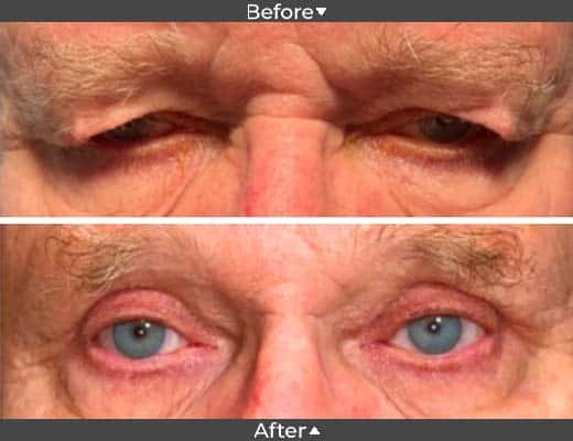 Ptosis and Upper Lid Blepharoplasty