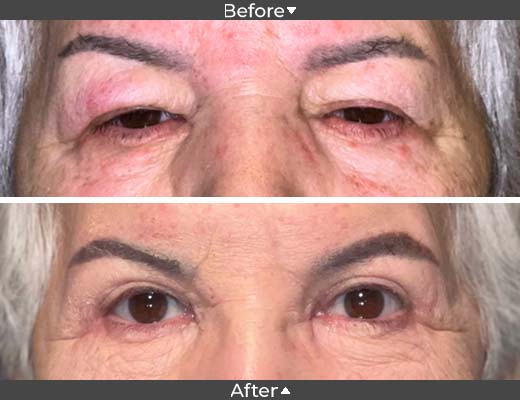 Ptosis and Upper Lid Blepharoplasty