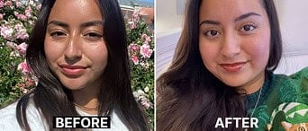 Young woman before and after eyelid surgery at Assil Gaur Eye Institute.