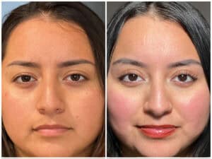 Blepharoplasty Before and after, Kim
