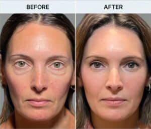 Alyssa Assil Gaur Aesthetics Patient Before and After Image
