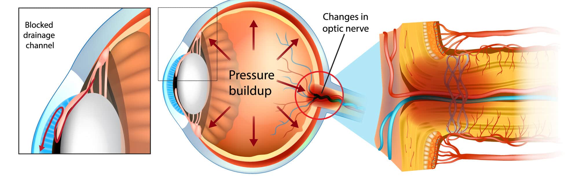Diagram showing glaucoma pressure buildup and optic nerve damage.