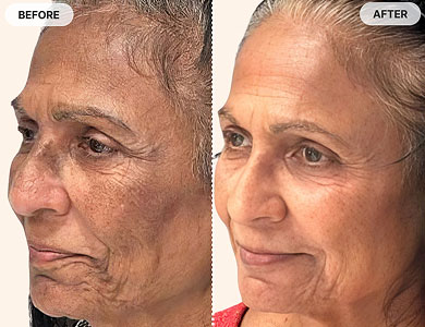 Non Surgical Aesthetics Before and After Pictures