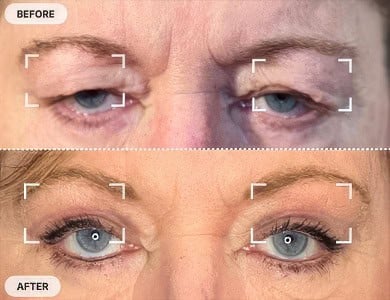 Blepharoplasty Before and After Pictures