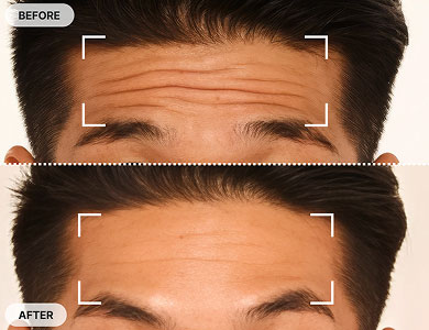 Close-up of man's forehead showing wrinkle reduction after Botox treatment.