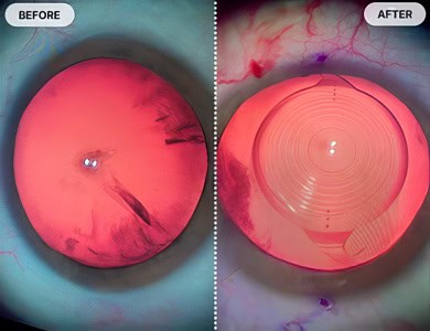 Cataract Before and After Pictures