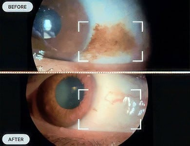 Eye Freckle Removal Before and After Pictures
